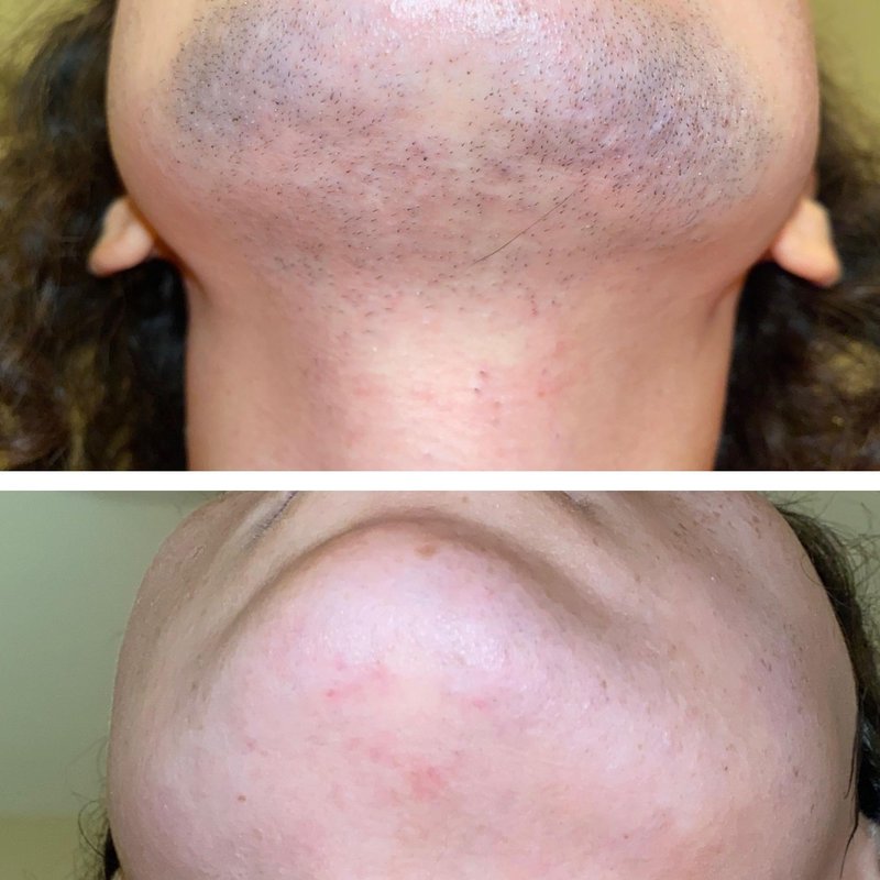 avant après thermolyse épilise résultat réel