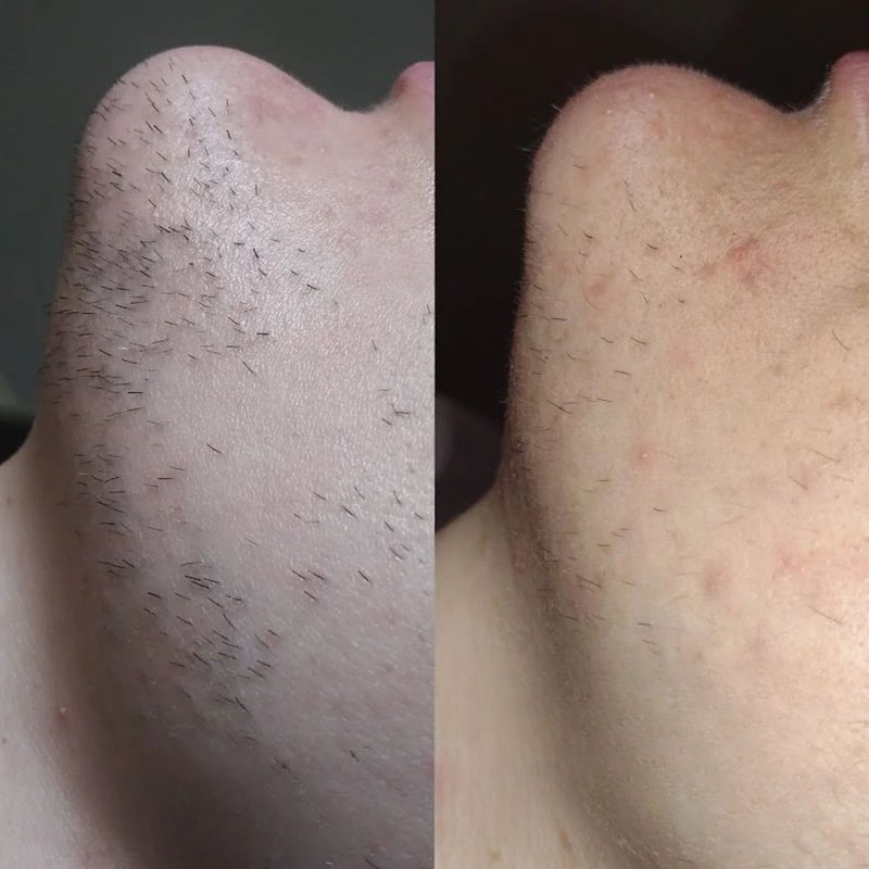 avant après thermolyse épilise résultat réel