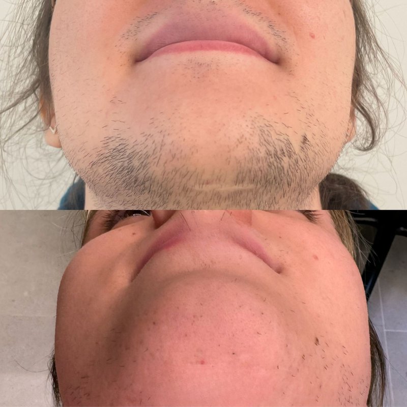 avant après thermolyse épilise résultat réel