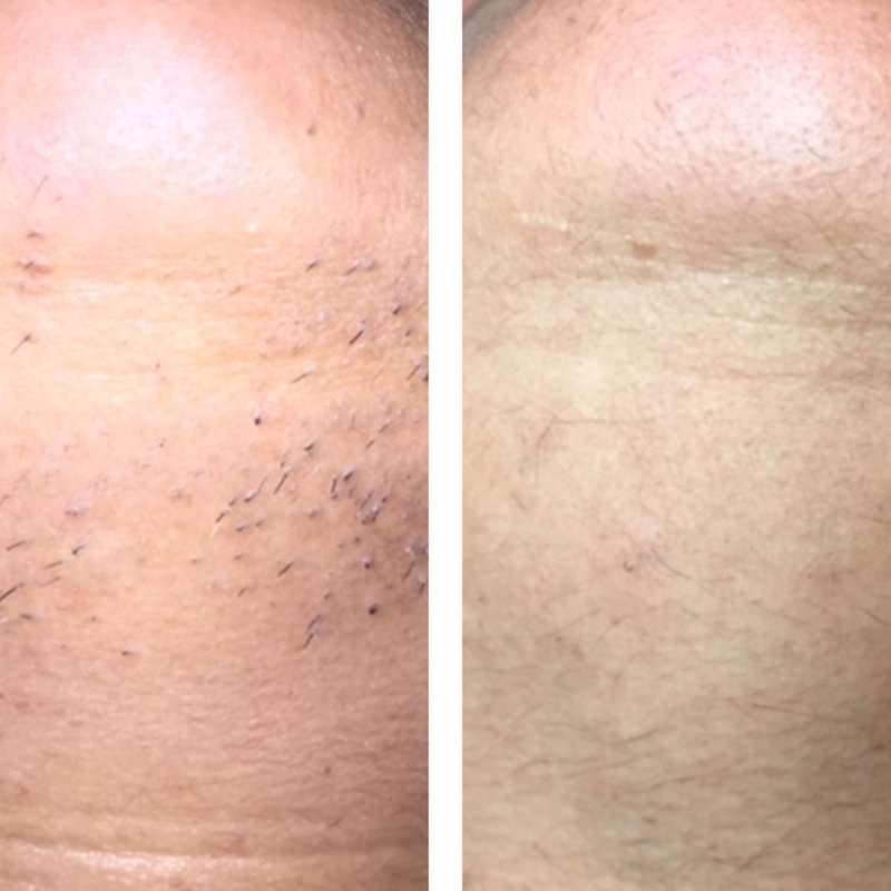 avant après thermolyse épilise résultat réel