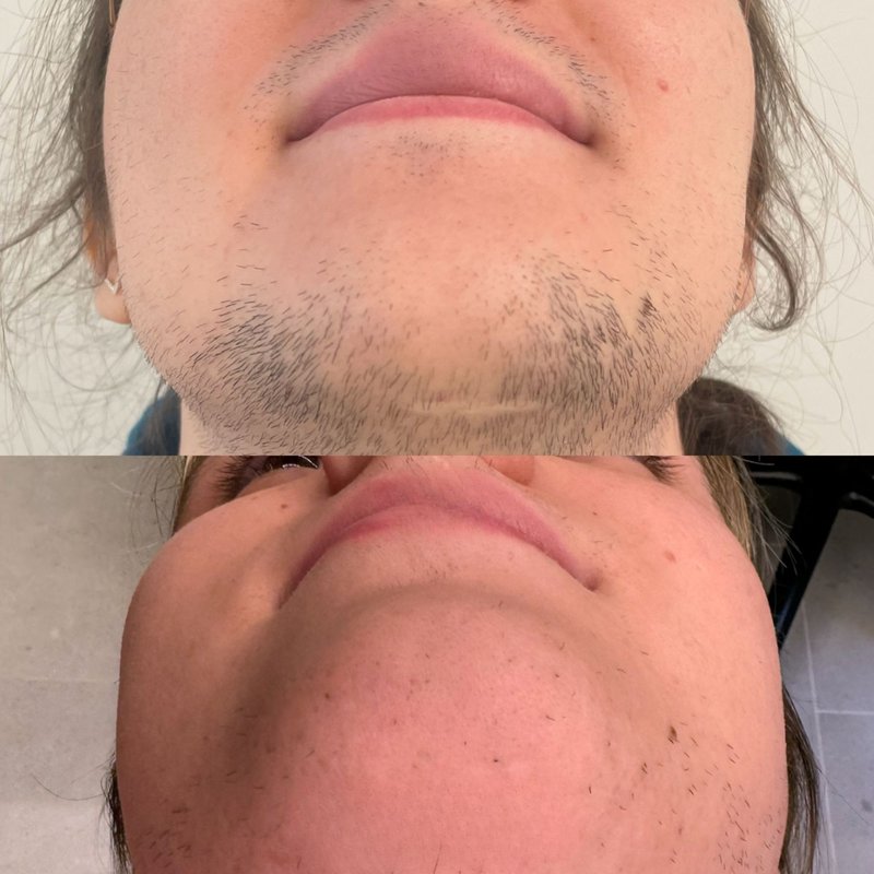 avant après thermolyse épilise résultat réel