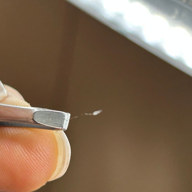 avant après thermolyse épilise résultat réel