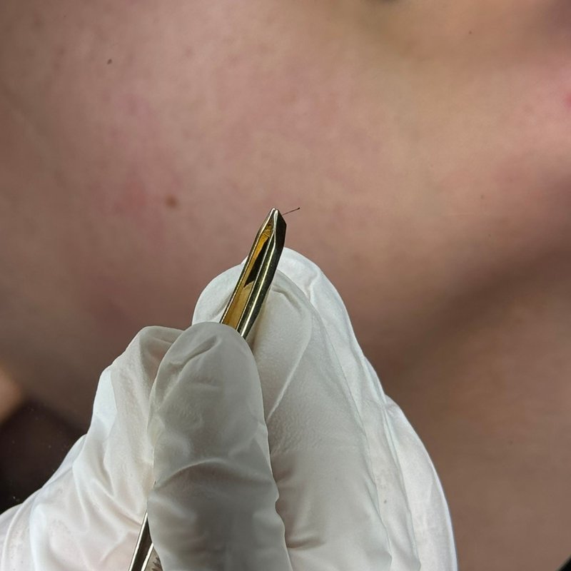 avant après thermolyse épilise résultat réel