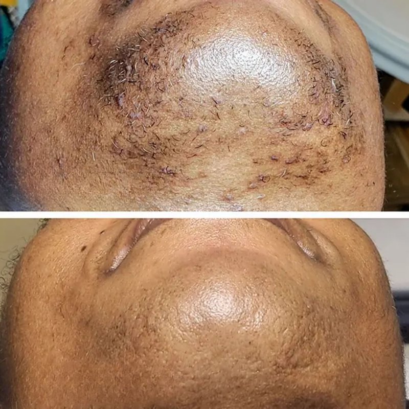 avant après thermolyse épilise résultat réel