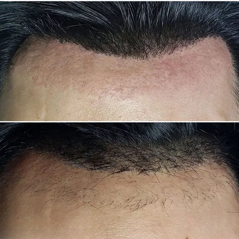 avant après thermolyse épilise résultat réel