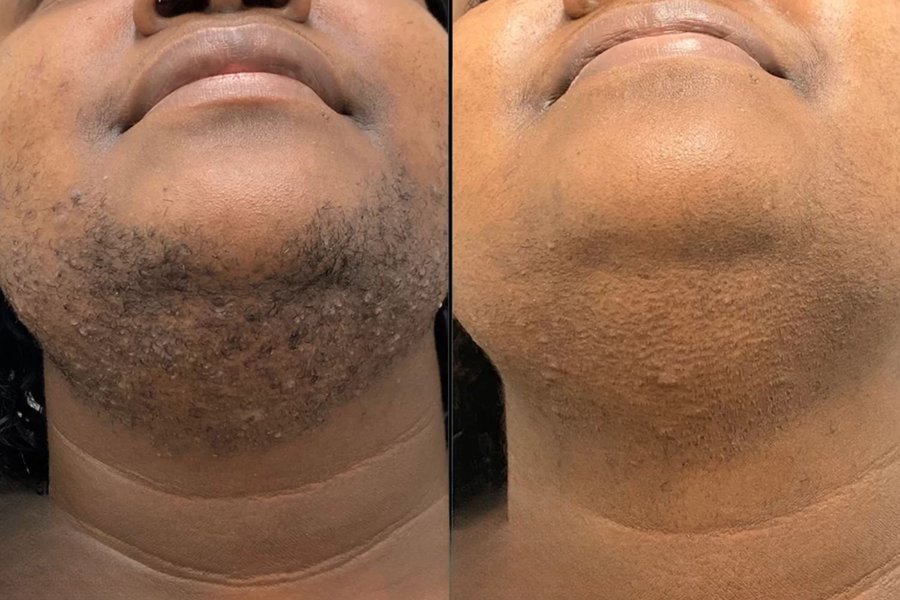 avant après thermolyse peau foncée menton