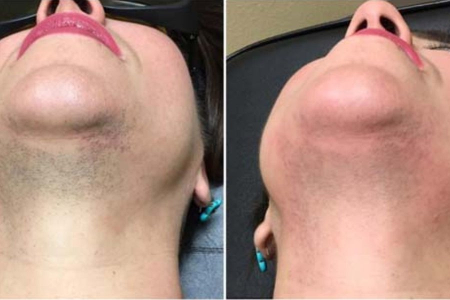 avant après thermolyse cou femme hirsutisme
