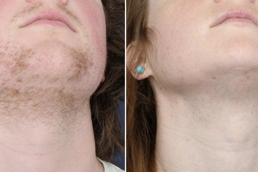 avant après thermolyse poils roux joue résultat