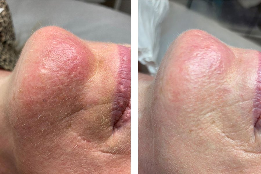 avant après thermolyse homme senior nez menton résultat