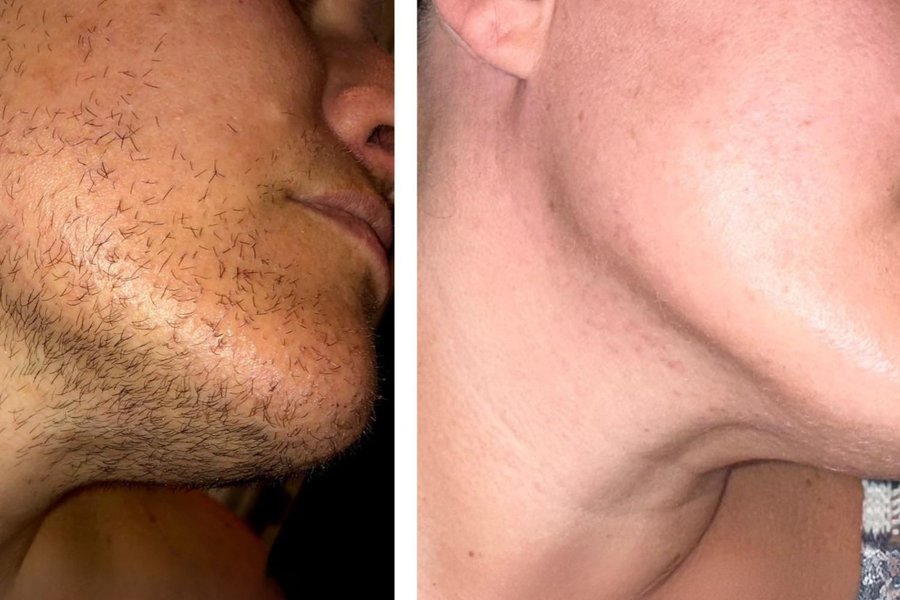 avant après thermolyse homme joue barbe