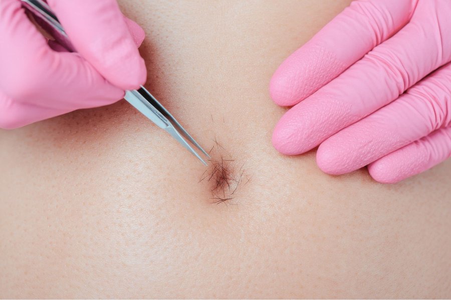 thermolyse épilation nombril poils incarnés pince