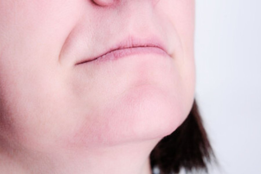 après thermolyse menton propre profil résultat