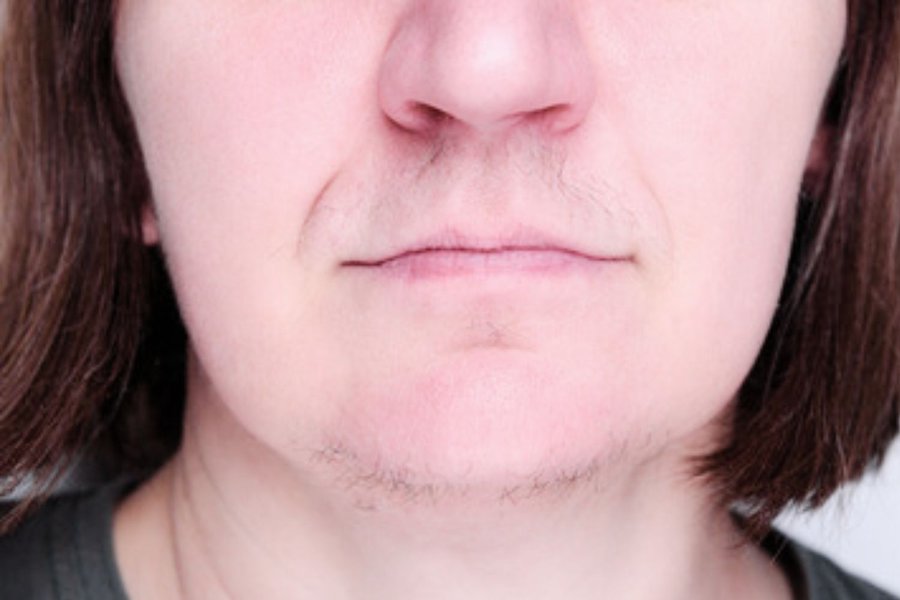 avant thermolyse hirsutisme menton face femme