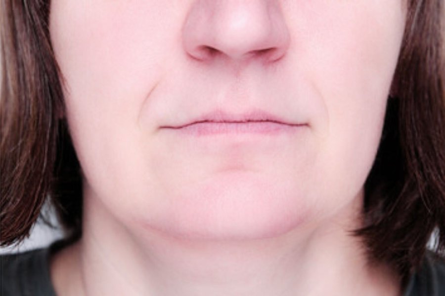 après thermolyse menton lisse résultat