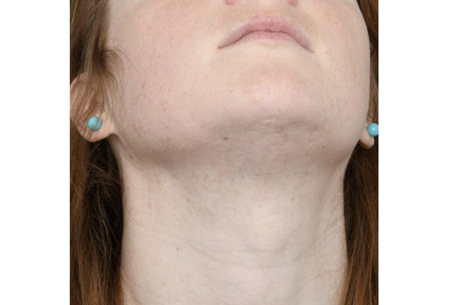 après thermolyse résultat définitif menton cou peau lisse